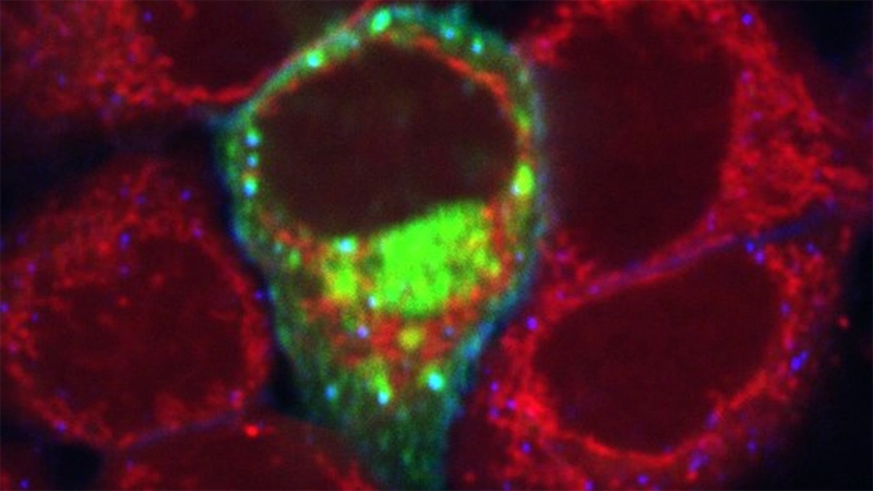 Breast cancer cells.