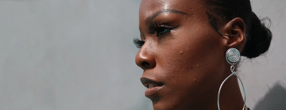 A portrait of Jasmine, an hidradenitis suppurativa (HS) advocate, journalist and filmmaker